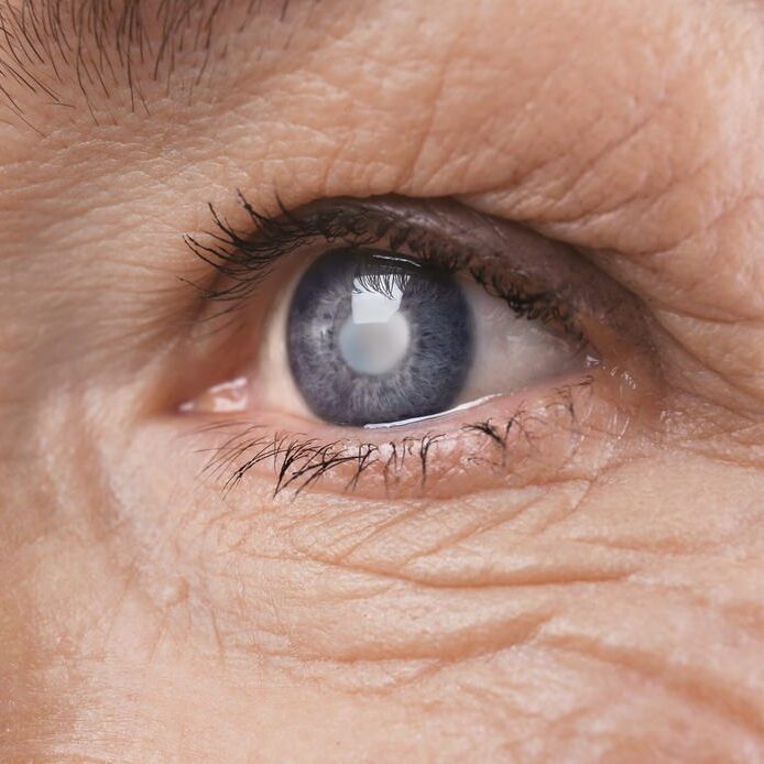 cataract-eye